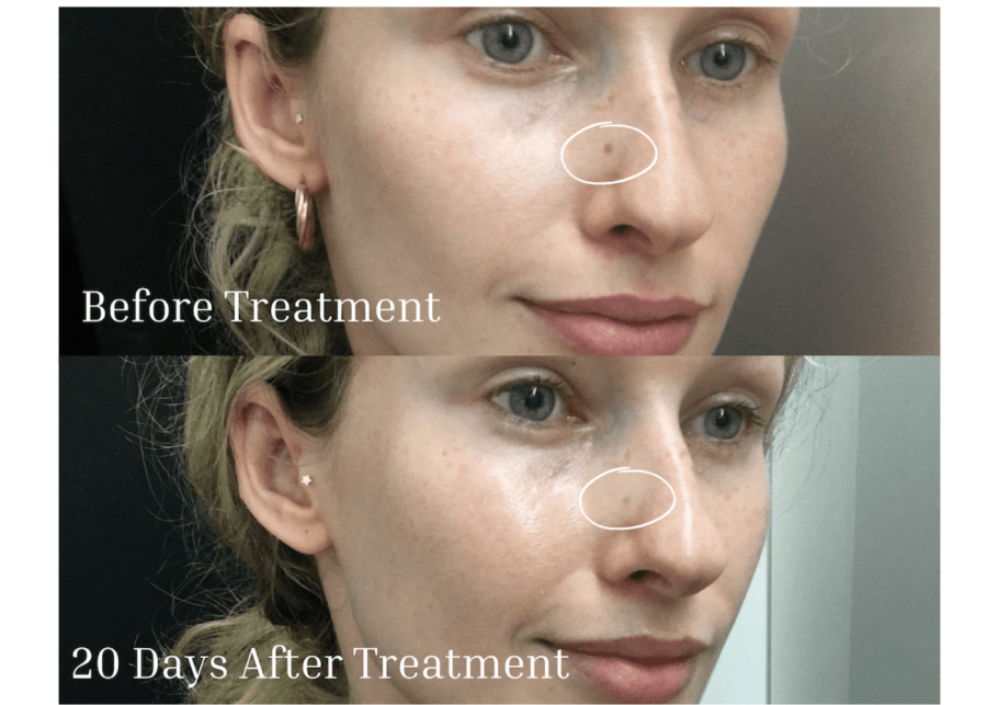 results from laser treatment