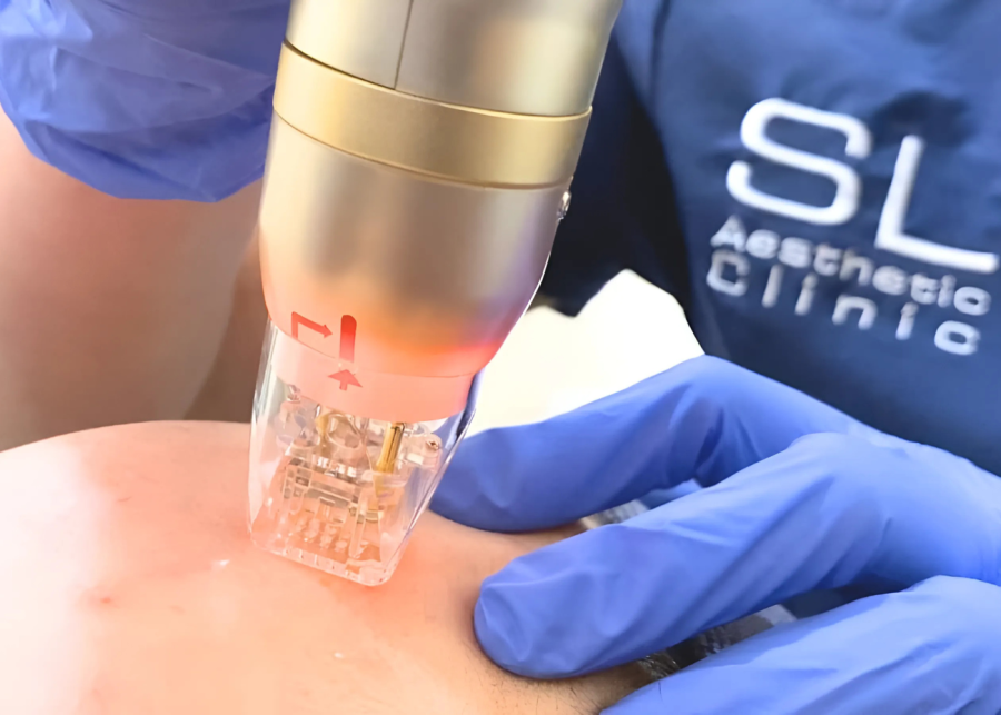Microneedling treatments in Singapore | SL Aesthetic Clinic
